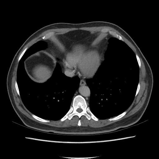 File:Active colonic bleed on CT (Radiopaedia 49765-55025 Axial C+ delayed 7).jpg
