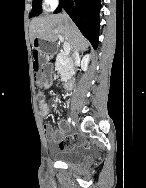 Active crohn disease (Radiopaedia 87133-103397 Sagittal C+ arterial phase 35).jpg