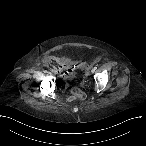File:Active renal extravasation with large subcapsular and retroperitoneal hemorrhage (Radiopaedia 60975-68796 Axial 310).jpg