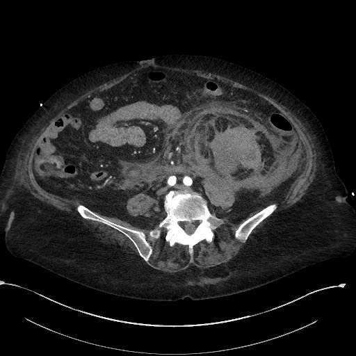 File:Active renal extravasation with large subcapsular and retroperitoneal hemorrhage (Radiopaedia 60975-68796 Axial C+ arterial phase 122).jpg