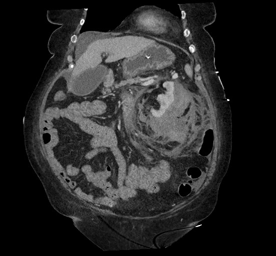 File:Active renal extravasation with large subcapsular and retroperitoneal hemorrhage (Radiopaedia 60975-68796 Coronal C+ portal venous phase 52).jpg