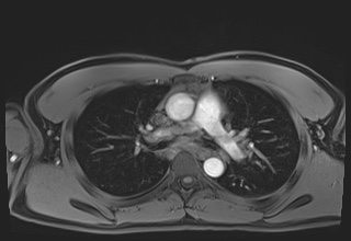File:Active right ventricular cardiac sarcoidosis (Radiopaedia 55596-62100 Axial Post contrast Dixon 24).jpg