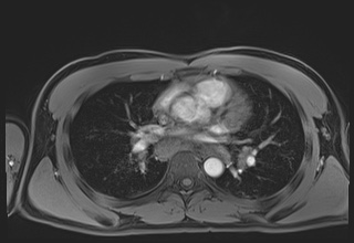 File:Active right ventricular cardiac sarcoidosis (Radiopaedia 55596-62100 Axial Post contrast Dixon 33).jpg
