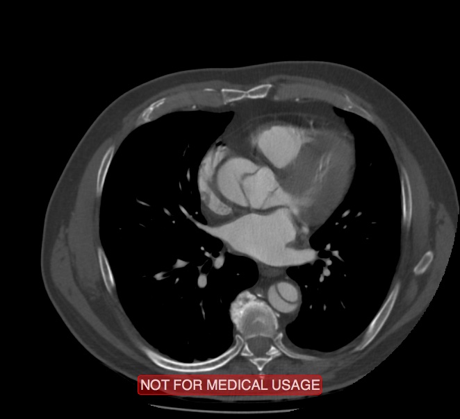 Acute aortic dissection - Stanford type A (Radiopaedia 40661-43285 Axial C+ arterial phase 38).jpg