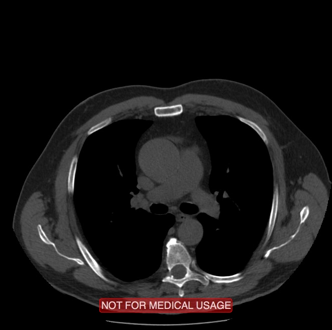 Acute aortic dissection - Stanford type A (Radiopaedia 40661-43285 Axial non-contrast 20).jpg
