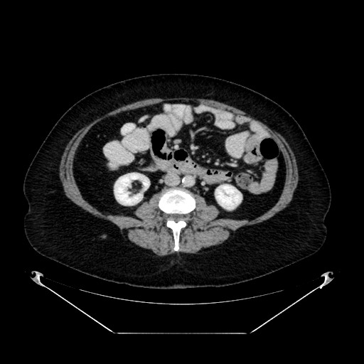 Acute appendicitis, heterotaxy syndrome (Radiopaedia 66884-76202 Axial C+ portal venous phase 67).jpg