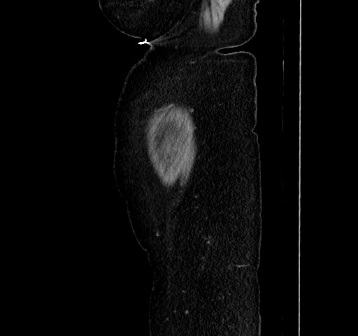 Acute appendicitis, heterotaxy syndrome (Radiopaedia 66884-76202 Sagittal C+ portal venous phase 123).jpg