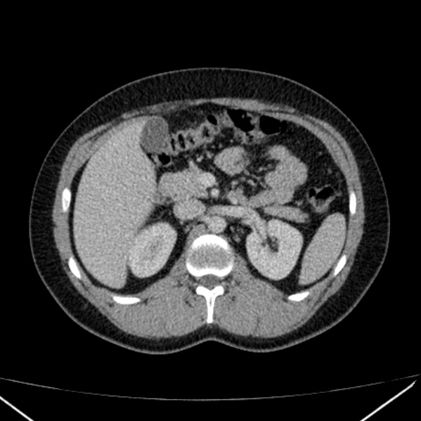 File:Acute appendicitis (Radiopaedia 38255-40270 Axial C+ portal venous phase 36).jpg