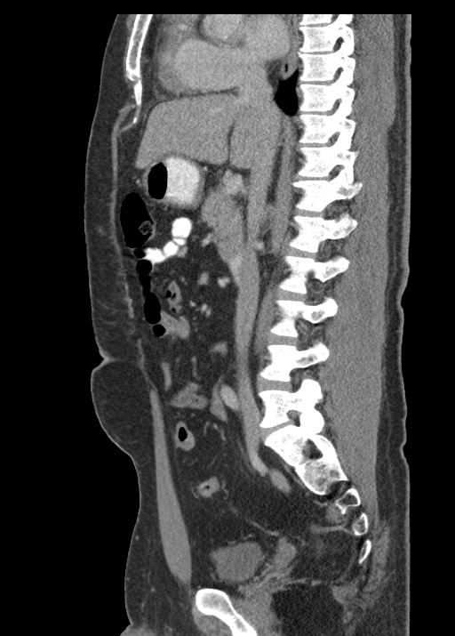 Acute appendicitis (Radiopaedia 48511-53463 Sagittal C+ portal venous phase 66).jpg