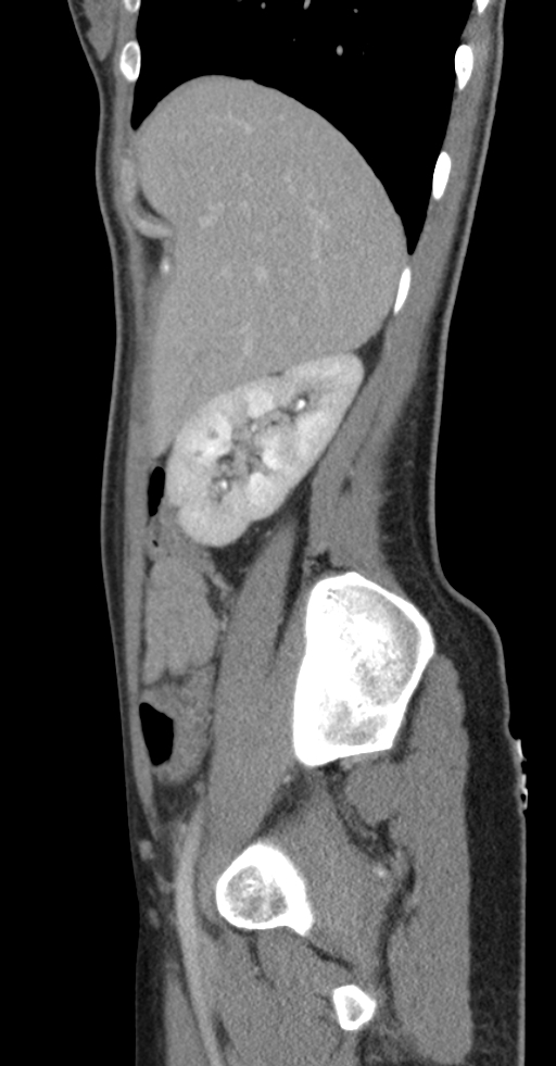 Acute appendicitis (Radiopaedia 62608-70901 Sagittal C+ portal venous phase 45).jpg