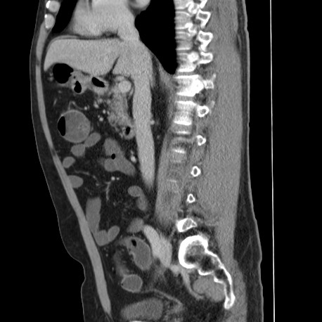 File:Acute appendicitis (Radiopaedia 66513-75790 Sagittal C+ portal venous phase 69).jpg