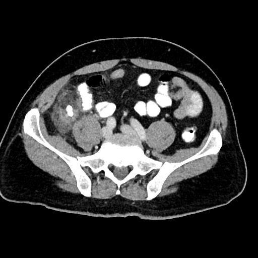 Acute appendicitis (Radiopaedia 77016-88960 Axial C+ portal venous phase 100).jpg