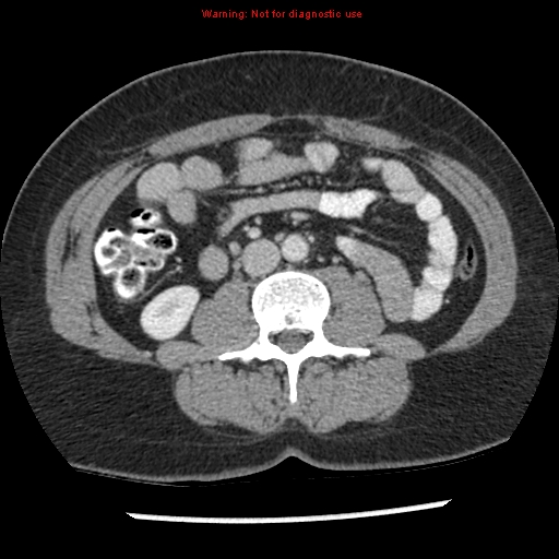File:Acute appendicitis (Radiopaedia 7966-8812 C+ portal venous phase 23).jpg