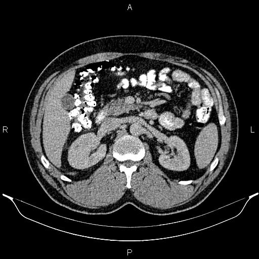 File:Acute appendicitis (Radiopaedia 84780-100240 Axial C+ portal venous phase 40).jpg