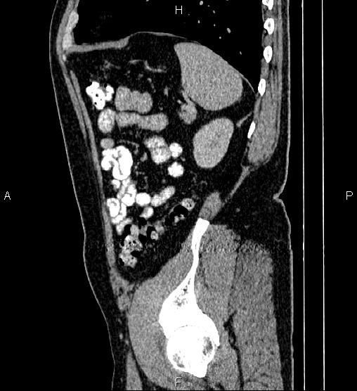 File:Acute appendicitis (Radiopaedia 84780-100240 Sagittal C+ portal venous phase 85).jpg