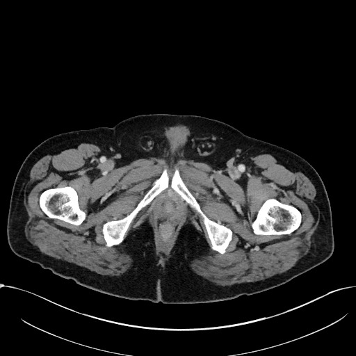 File:Acute appendicitis - large appendicoliths (Radiopaedia 61805-69820 Axial C+ portal venous phase 141).jpg