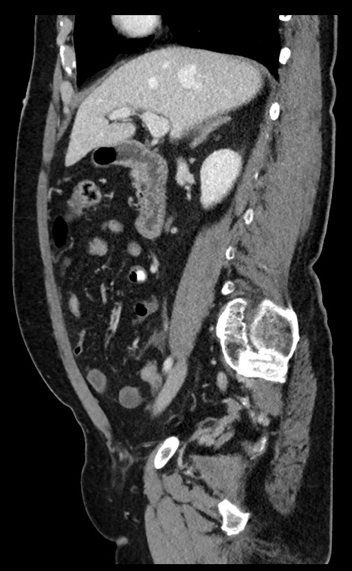 Acute appendicitis - large appendicoliths (Radiopaedia 61805-69820 Sagittal C+ portal venous phase 73).jpg