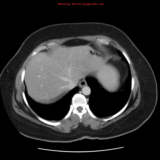 Acute appendicitis complicated by ovarian vein thrombophlebitis (Radiopaedia 16172-15851 Axial C+ portal venous phase 18).jpg
