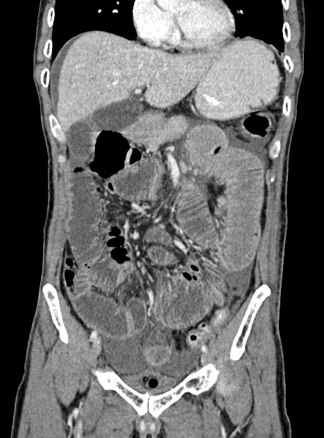 Acute bowel ischemia (Radiopaedia 87695-104114 Coronal C+ portal venous phase 167).jpg