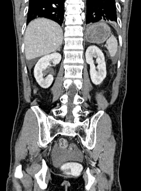 Acute bowel ischemia (Radiopaedia 87695-104114 Coronal C+ portal venous phase 277).jpg