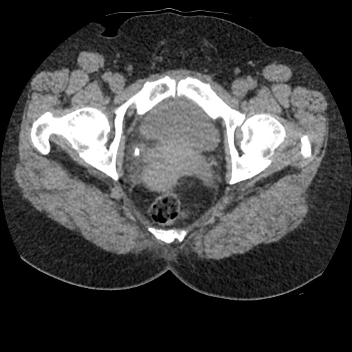 Acute cholecystitis and ureteric colic (Radiopaedia 42330-45444 Axial prone 106).jpg