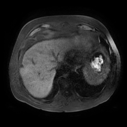 File:Acute cholecystitis complicated by pylephlebitis (Radiopaedia 65782-74915 Axial T1 fat sat 10).jpg