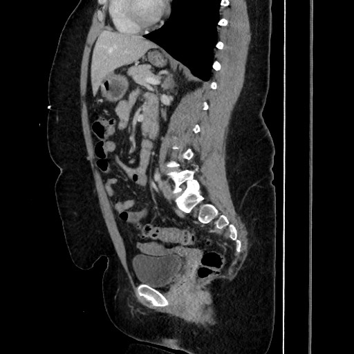Acute diverticulitis - transverse colon (Radiopaedia 87063-103327 Sagittal C+ portal venous phase 134).jpg
