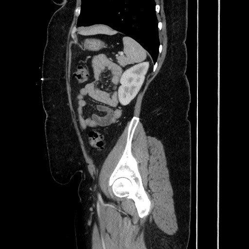 Acute diverticulitis - transverse colon (Radiopaedia 87063-103327 Sagittal C+ portal venous phase 164).jpg