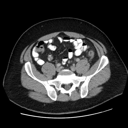 Acute diverticulitis with localized perforation (Radiopaedia 41296-44113 Axial C+ portal venous phase 66).jpg