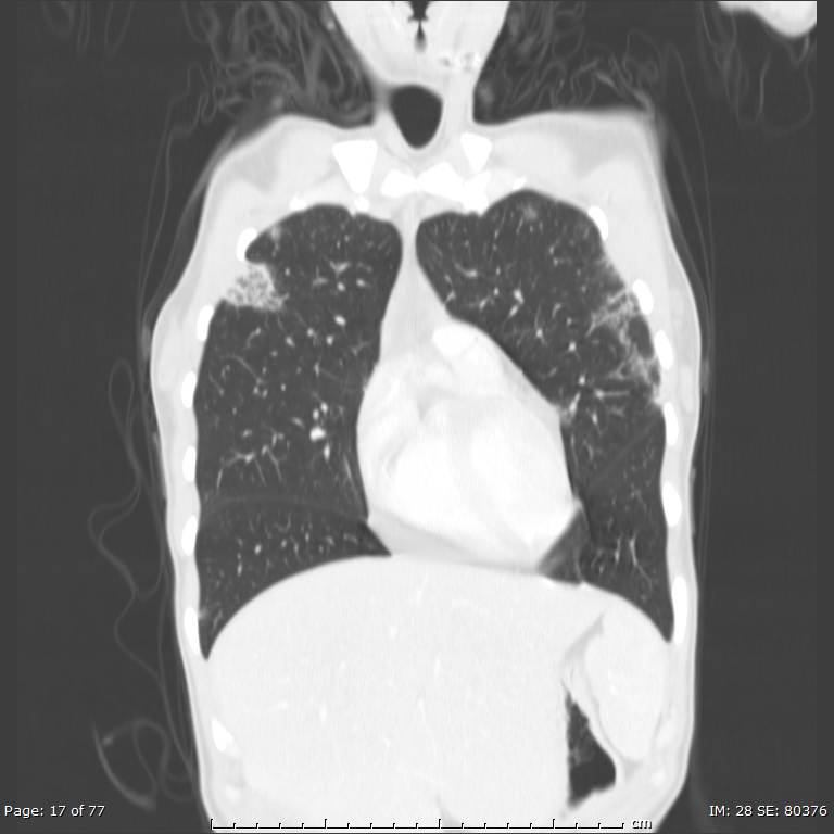 Acute eosinophilic pneumonia (Radiopaedia 48211-53073 Coronal lung window 10).jpg