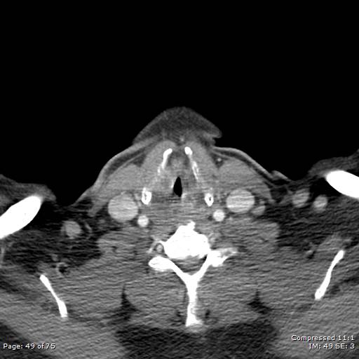 Acute epiglottitis (Radiopaedia 54375-60590 Axial C+ arterial phase 49).jpg