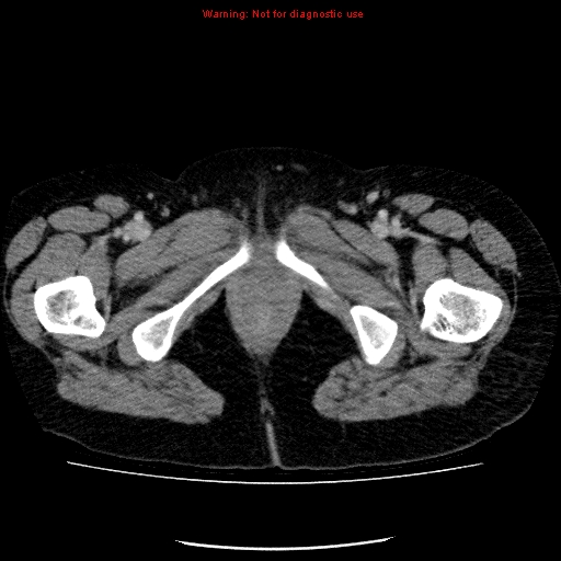 Acute gangrenous cholecystitis (Radiopaedia 10123-10661 Axial C+ portal venous phase 107).jpg