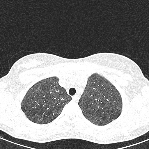 File:Acute hypersensitivity pneumonitis (Radiopaedia 85293-100870 Axial lung window 22).jpg