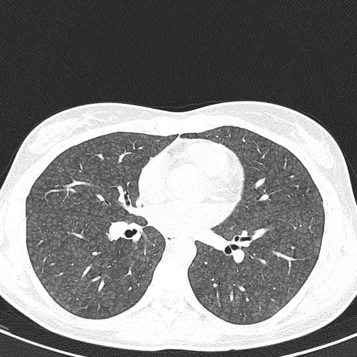File:Acute hypersensitivity pneumonitis (Radiopaedia 85293-100870 Axial lung window 64).jpg