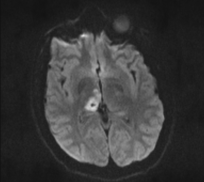 Acute ischemic stroke - posterior circulation territory (Radiopaedia 77670-89880 Axial DWI 35).jpg