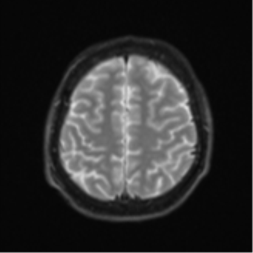 Acute left middle cerebral artery territory infarct with clot retrieval (Radiopaedia 47732-52433 Axial DWI 24).png