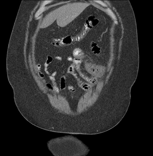 Acute mesenteric venous ischemia (Radiopaedia 46041-50383 Coronal C+ portal venous phase 18).jpg