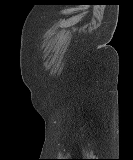 Acute mesenteric venous ischemia (Radiopaedia 46041-50383 Sagittal C+ portal venous phase 117).jpg
