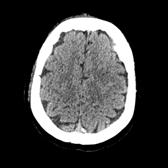 Acute middle cerebral artery territory infarct (Radiopaedia 52380-58283 Axial non-contrast 83).jpg