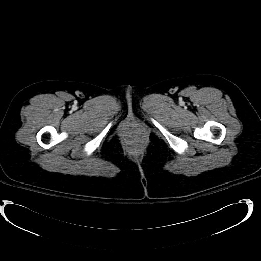 Acute myocardial infarction in CT (Radiopaedia 39947-42415 Axial C+ portal venous phase 150).jpg
