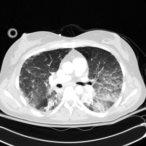 File:Acute myocardial infarction in CT (Radiopaedia 39947-42415 Axial lung window 57).jpg