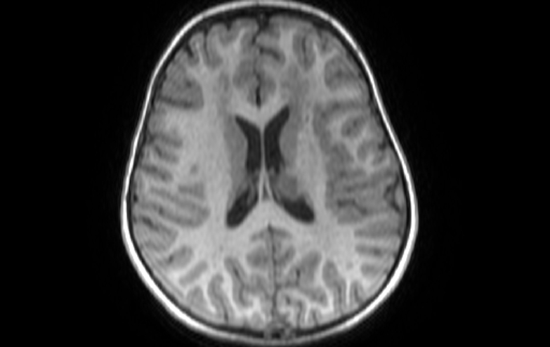 Acute necrotizing encephalitis of childhood (Radiopaedia 67356-76737 Axial T1 36).jpg