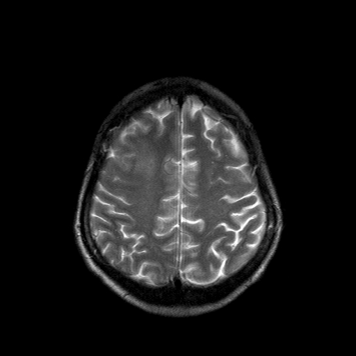 File:Acute necrotizing toxoplasma encephalitis (Radiopaedia 10683-11149 Axial T2 4).jpg