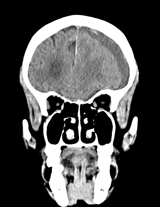 Acute on chronic subdural hematoma (Radiopaedia 74814-85823 Coronal non-contrast 19).jpg