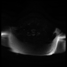 Acute otitis externa (Radiopaedia 57296-64236 Axial DWI 26).jpg