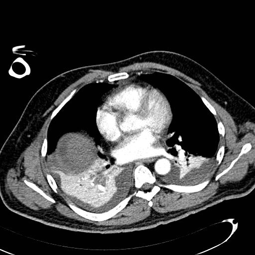 File:Acute pancreatic necrosis (Radiopaedia 13560-13486 Axial C+ portal venous phase 5).jpg
