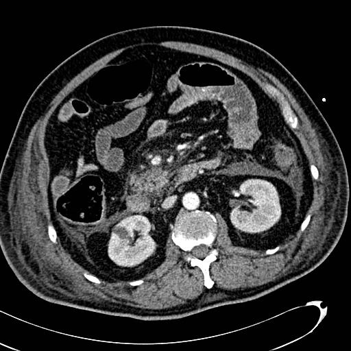 File:Acute pancreatic necrosis (Radiopaedia 13560-13486 Axial C+ portal venous phase 72).jpg