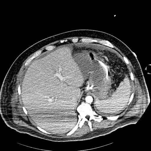 File:Acute pancreatic necrosis (Radiopaedia 13560-18502 Axial C+ portal venous phase 2).jpg