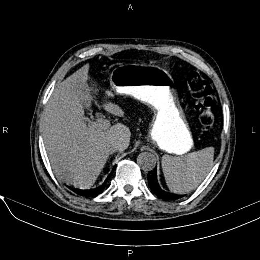 Acute pancreatitis (Radiopaedia 85146-100701 Axial non-contrast 30).jpg