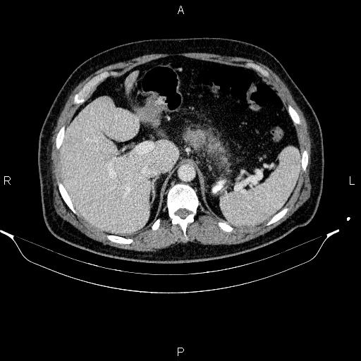 Acute pancreatitis (Radiopaedia 85390-101010 Axial C+ portal venous phase 26).jpg